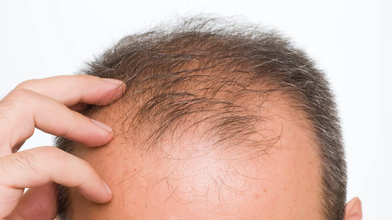 Popular Hair Loss Medication May Increase Depression And Suicidal Thoughts, Warns Study