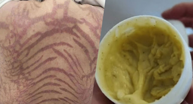 Shocking Case: Unlabeled Beauty Cream Causes Scaly Skin Pattern